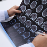 Esclerose múltipla é a principal causa de incapacidade neurológica em jovens adultos